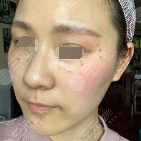 激光医院祛斑价格全面解析，美丽不留遗憾！